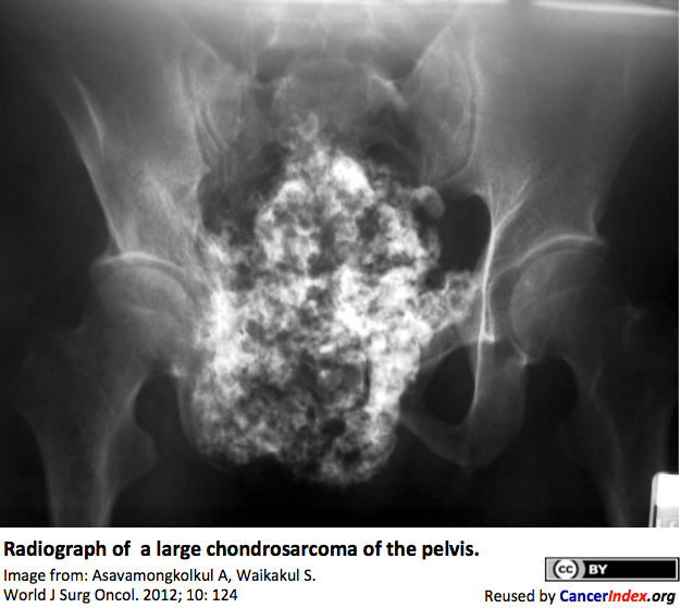 radiograph of pelvic chronrosarcoma