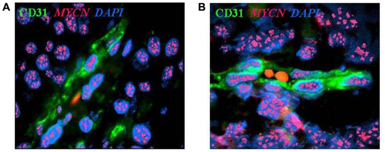 FISH analysis on neuroblastoma from Pistoia et al., Front Oncol. 2012; 2: 174. License: CC BY 3.0