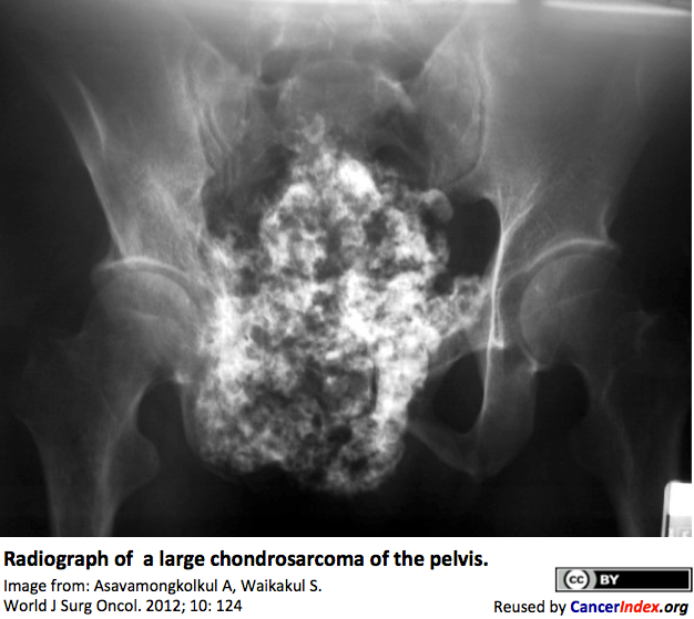 Chondrosarcoma | CancerIndex